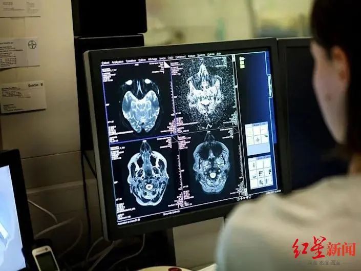 新冠病毒|84%感染者出现后遗症!最新研究:新冠病毒还能杀死脑细胞