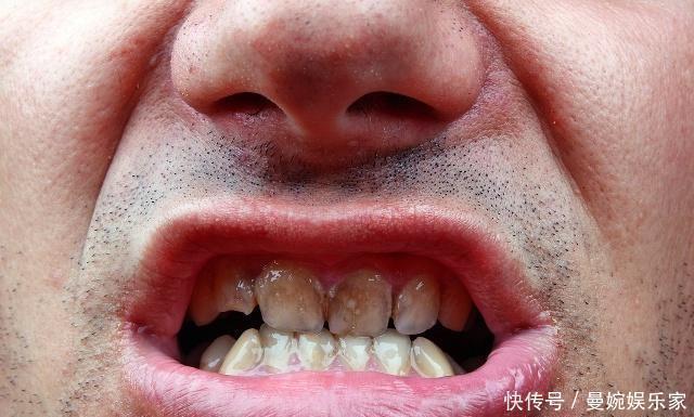 牙缝抠出石头,臭烘烘让人很尴尬?学会小