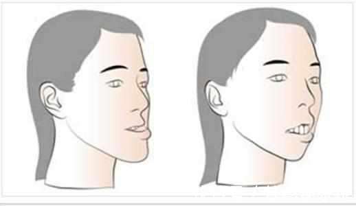 矫正|儿童做牙齿矫正三个最佳时间:家长要牢记,矫治越早干预效果越好