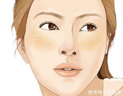 痘印怎么去?平时做好4件事戒掉3种食物,帮你远离痘印烦恼!