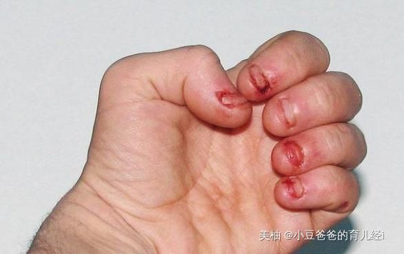 喜欢“啃指甲”的孩子,长大后会变成啥样医生逃不过两个结局