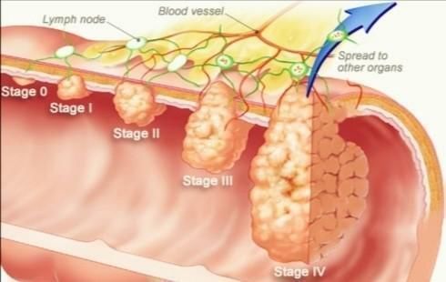 患者|便血患者要注意——千万别把痔疮和肠癌混为一谈
