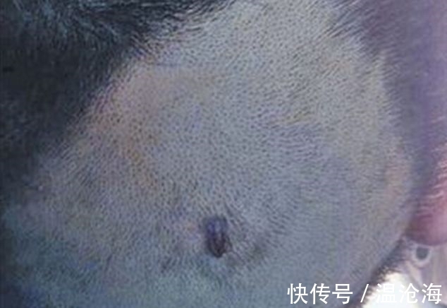 蜱虫|4岁女儿高烧不退,呕吐不止,拨开头发,怀孕准妈妈怒扇婆婆耳光