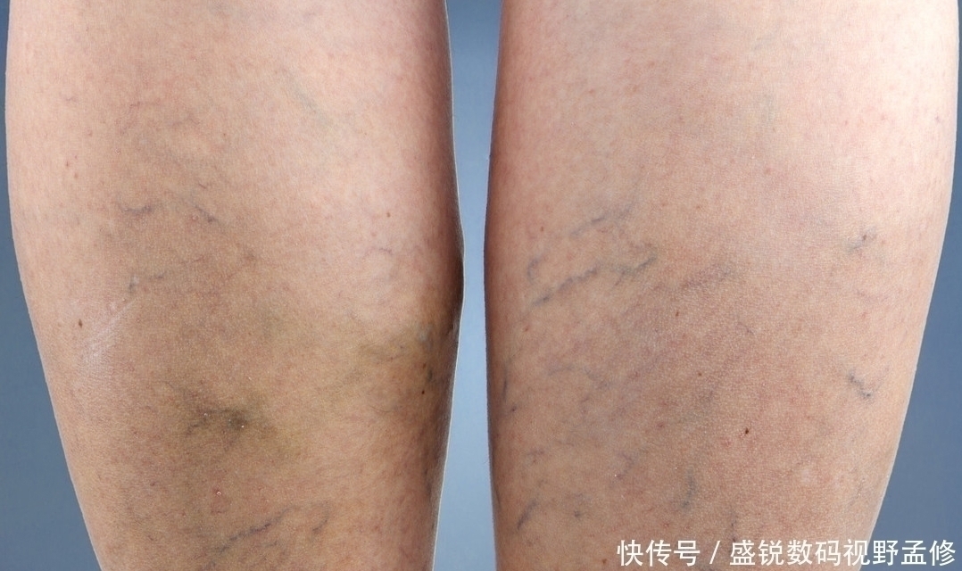 姬松|脑部供血不足,如少做2件事,养成3习惯,脑血管或可干净畅通