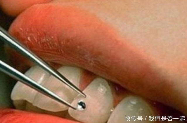 钻石|土豪的世界我们果然不懂,牙齿上面镶钻,你能接受吗?