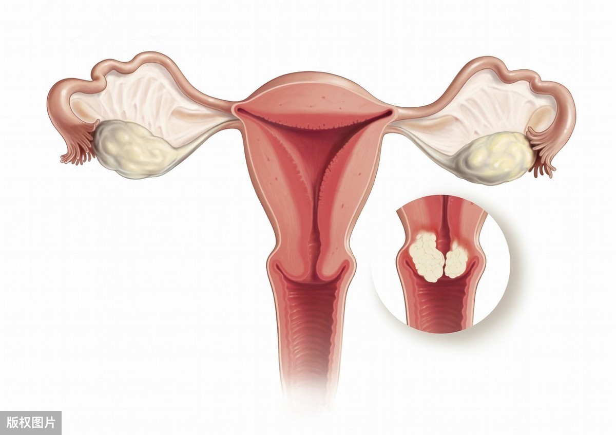 放疗|患上宫颈癌还能活多久医生早做好2件事,还宫颈安康