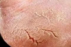 瘙痒|秋冬皮肤干又痒,为啥有人一脱秋裤像“下雪”?