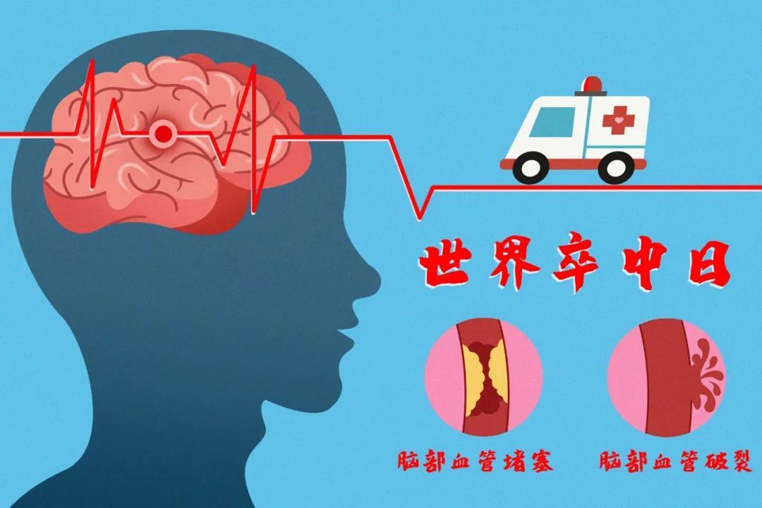 脑卒中|男子才30多岁就中风了！我国患病人数超2800万，这些症状要当心