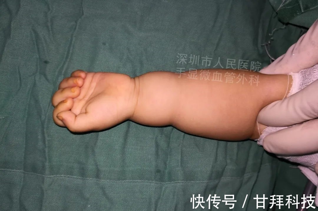 男孩|得了这病,12岁男孩手指比香蕉还粗!7种常见的手部畸形,家长们要注意