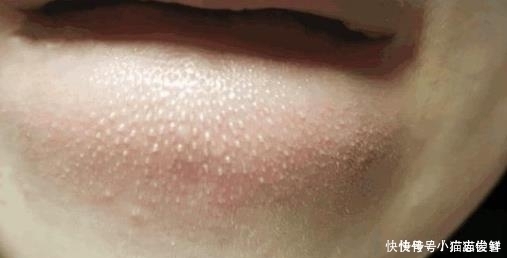 小疙瘩|抿紧下巴后突起的“白疙瘩”,千万要注意,这是螨虫的真身吗?