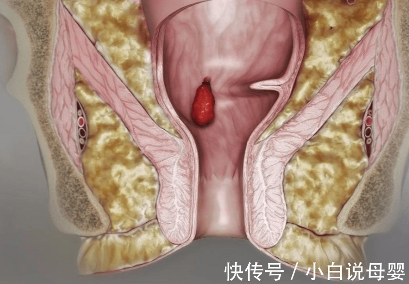 痔核|痔疮症状不可忽视!缓解痔疮问题还得是对症下药!
