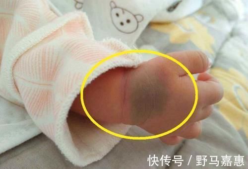 产科大夫|胎记是怎么来的?产科大夫:天生的除外,孕期这3种行为尽量避开