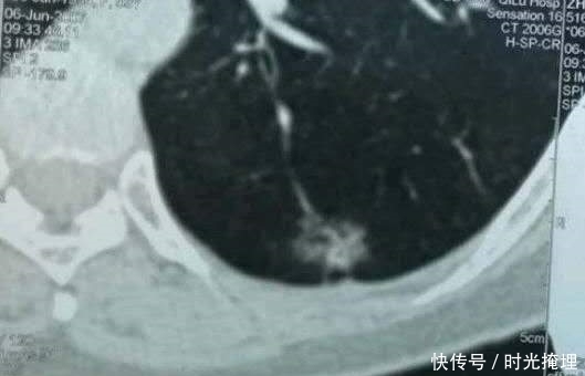 化疗|化疗会造成癌症扩散吗?