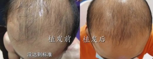 门诊部 男子去植发,15元1根,付款后惊呆了:根本还不起