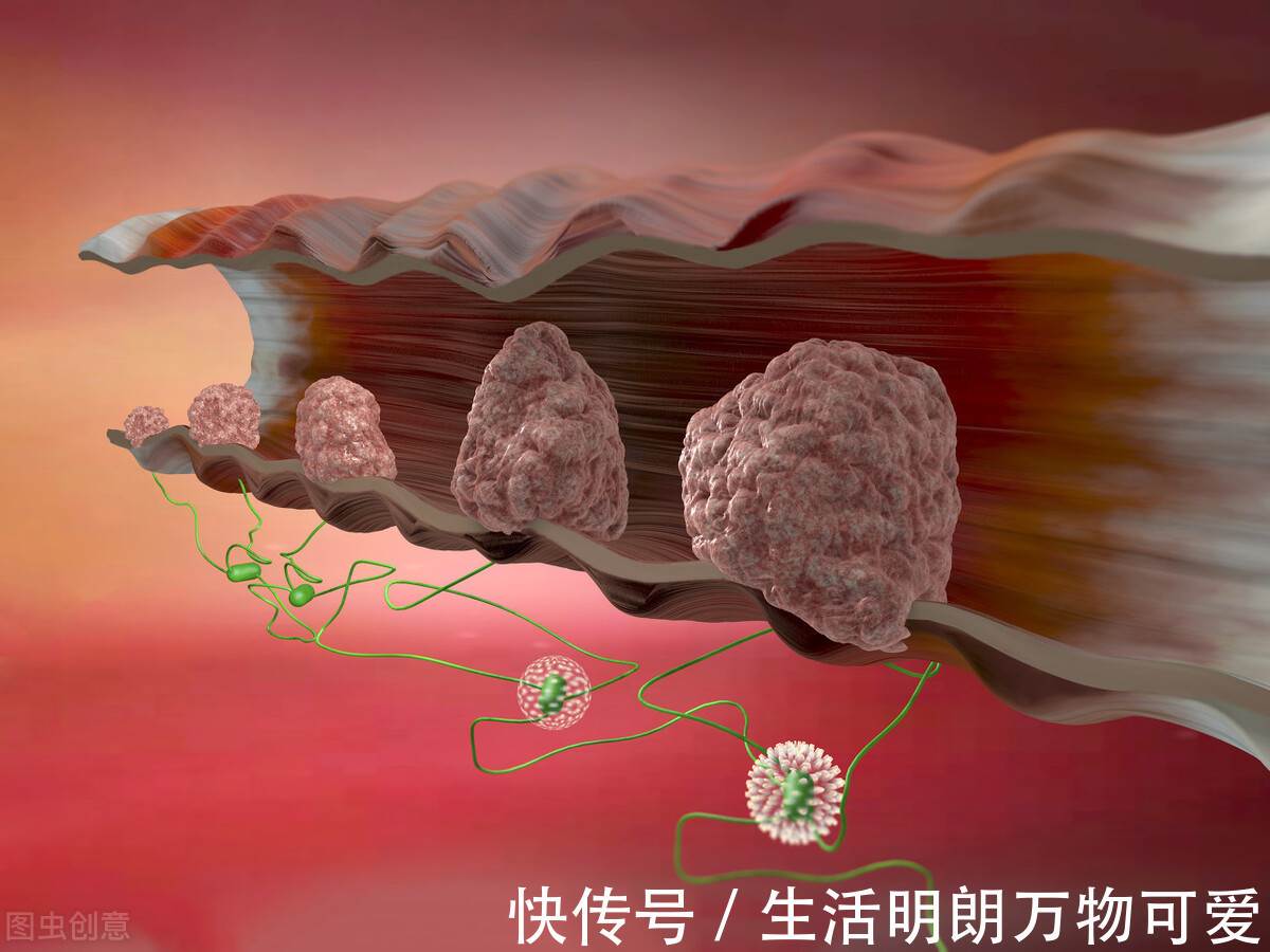 阿健|直肠癌多半是“拖”出来的!医生提醒:身体有2个感受,抓紧检查