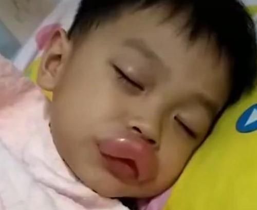 葡萄|熊孩子偷吃了一颗葡萄,嘴巴变成了香肠嘴,医生看了都憋笑