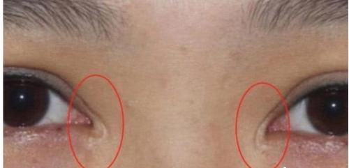 想开眼角又担心留疤，开眼角疤痕增生多久会消失？