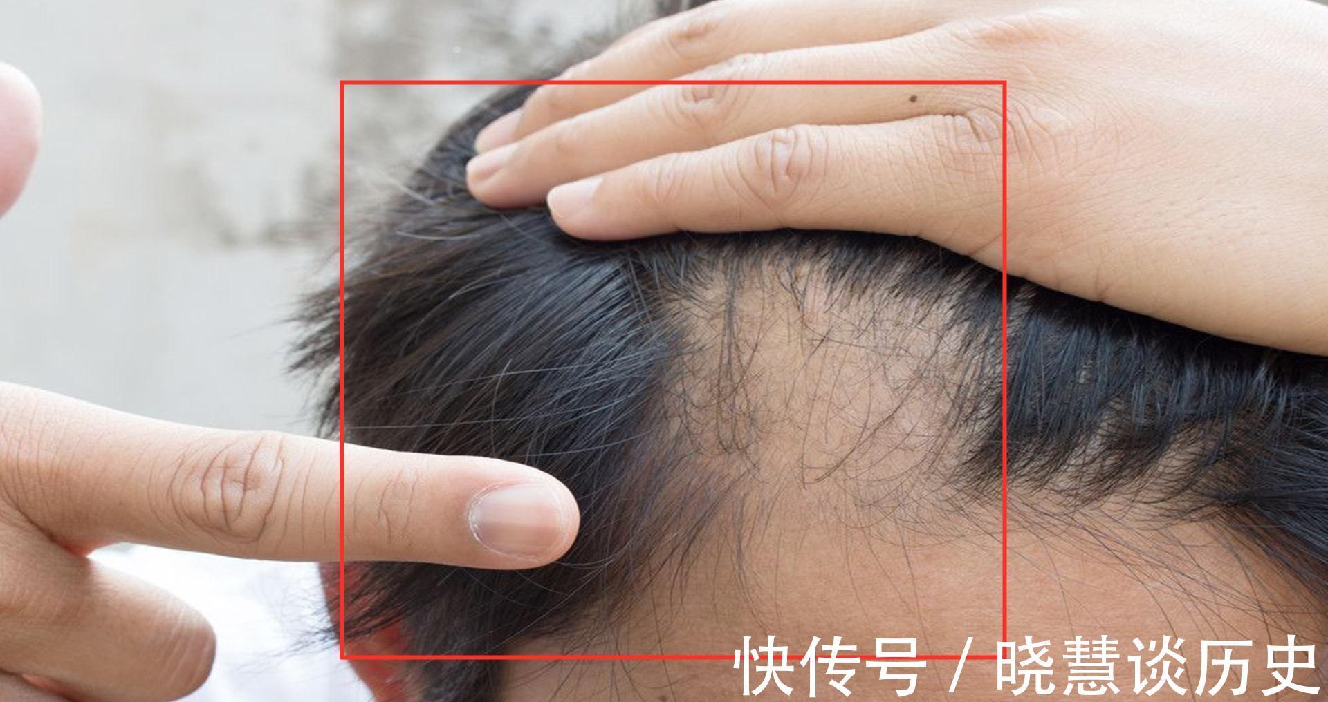 基因|每天掉超过100根头发是脱发？脱发5大元凶，少碰为妙