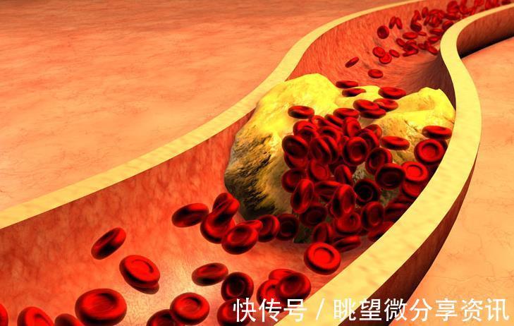 52岁大爷血管犹如20岁小伙,平时常吃4种食物,血管科医生:做得好!