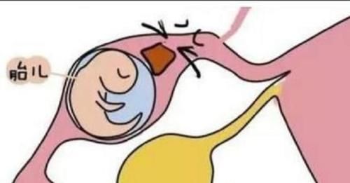 种人|宫外孕很可怕，这6种人最容易被盯上，看看有没有你！