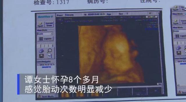 胎儿缺氧后果严重,3个方法判断“是否缺氧”,孕妈们别大意