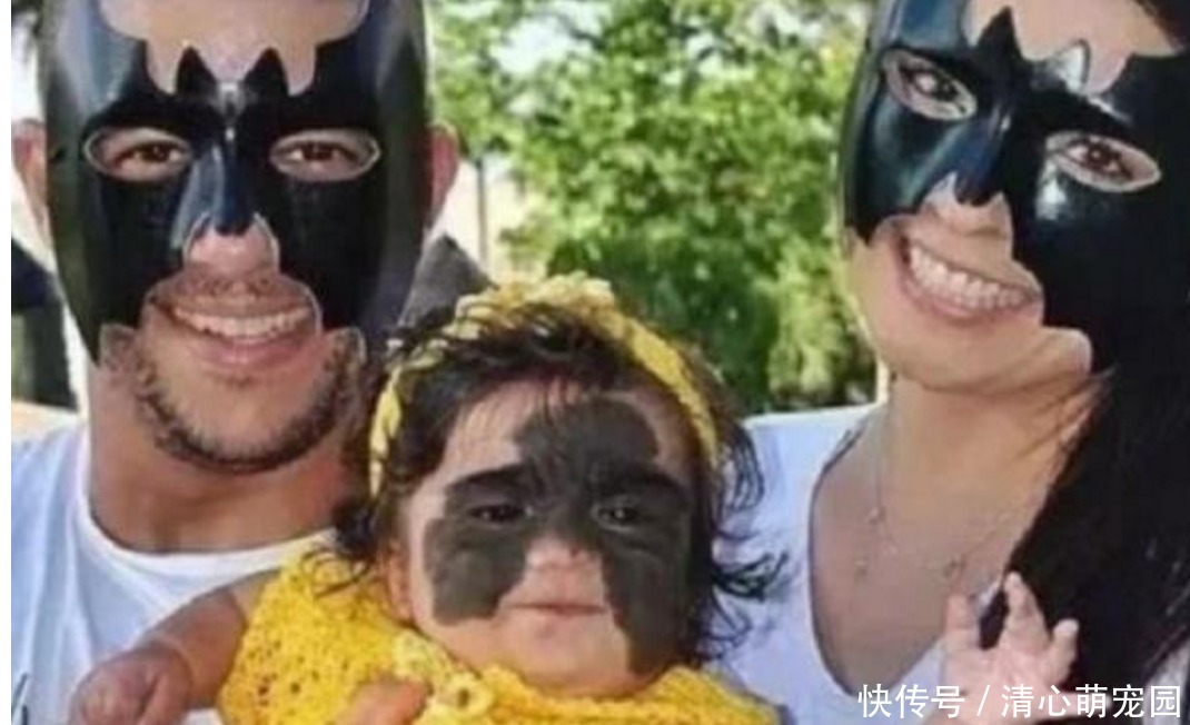 女婴一出生伴随“蝙蝠侠印记”,被父母送去整容7次,结果怎样了