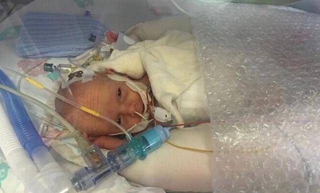 阿乐|英国妇女在怀孕21周时生下一个孩子宝宝是透明的,可以看到体内的血液流动