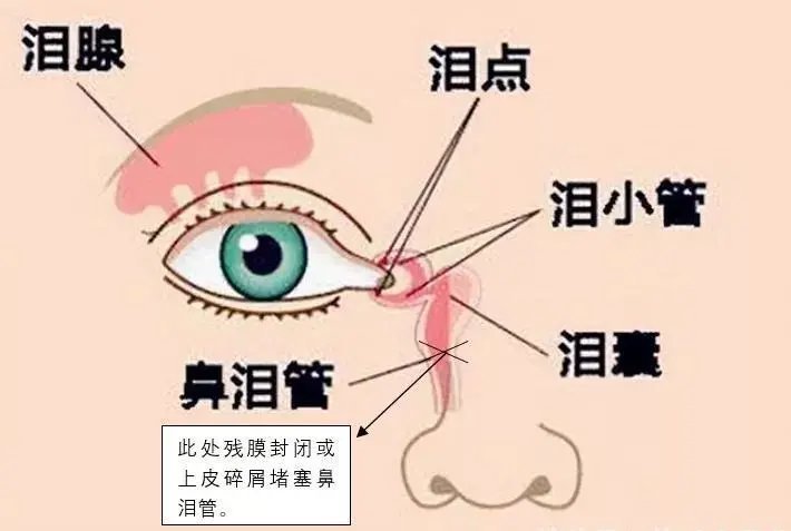 泪道|眼角抽出5管脓液，宝宝眼睛经常“泪汪汪”居然是病！拖延治疗严重的可能失明