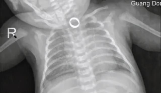 可可|满月婴儿手上戴满“金戒指”,误吞一只险些悲剧,爸妈长点心吧