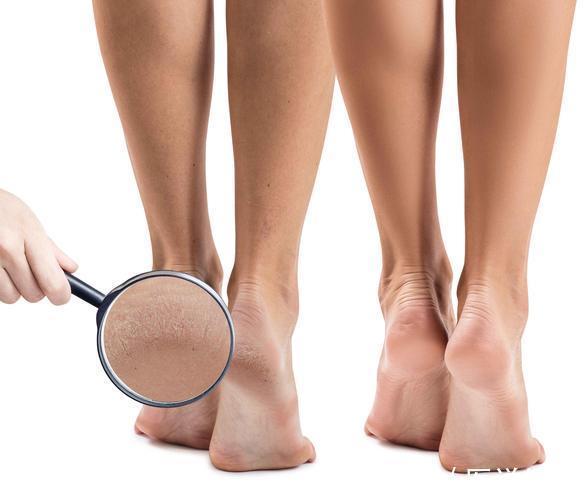 血糖控制|糖尿病足来临前,双脚或有4种异常表现,糖友们早知早好,别忽视