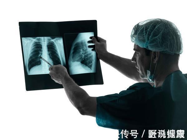 肺部|肺癌越来越普遍?患上肺癌的人,一般有4个“共性”,希望你没有