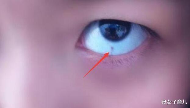 医生|3岁宝宝眼白出现黑点,怎么回事儿听了医生的答案,终于放心了