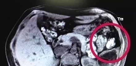 B超检查|做了多次B超检查还是没发现胎儿,医生详细检查后,不由大吃一惊