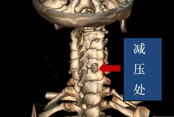 刘大姐|7mm的钥匙孔手术，解决颈椎病大难题