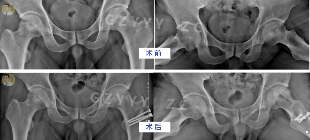 手术|看准、选对、做好——股骨头坏死保髋就这样成功了？