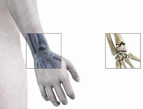 结肠癌|大肠癌的罪魁祸首已经找到，晨起坚持三个习惯，肠道才会更健康