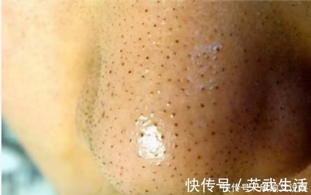 黑头|常见的4种错误的除黑头方法,奉劝:不要再用了,越除黑头越多