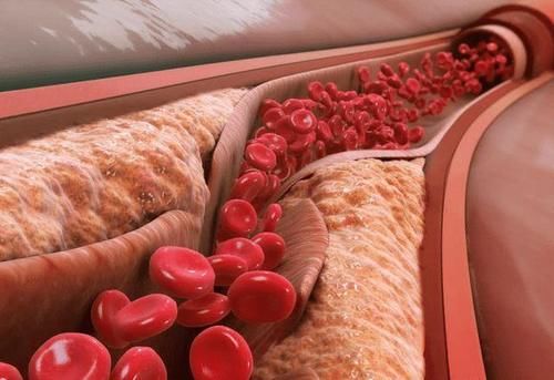 高血脂|常吃馒头不利于血脂稳定？医生：这“2白”尽量避开