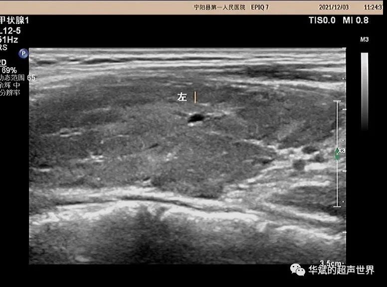 淋巴结|超声问答丨这个颈部淋巴结应该如何考虑？