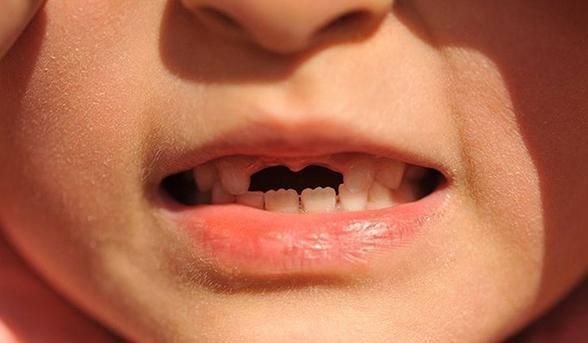 糖果|越来越多孩子长“双排牙”，与糖果无关，是父母喂养有误区