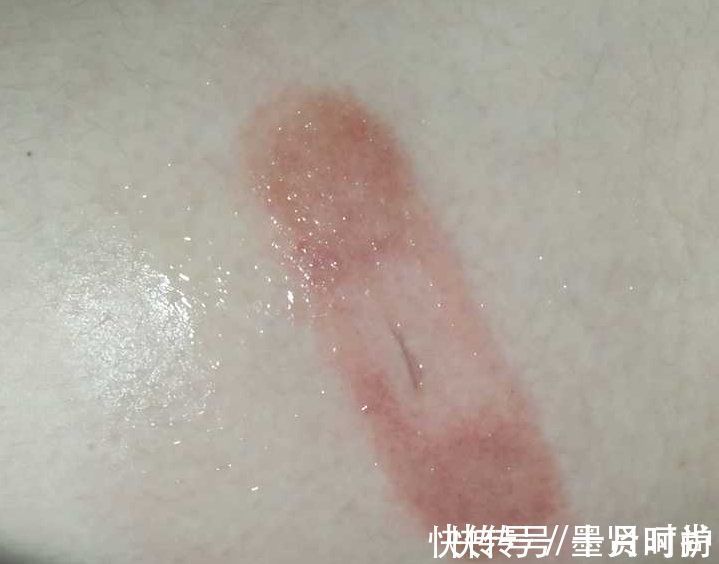 手指|三岁女童被活活截断手指,终生残疾!只因用错创可贴,快自查