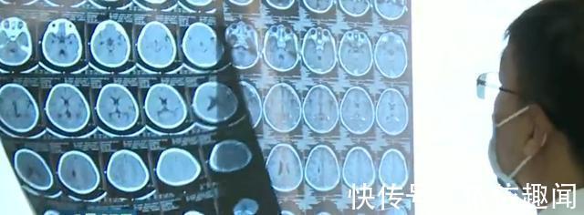 癫痫|4岁女童头上的胎记,一查竟是血管瘤,医生给出了答案
