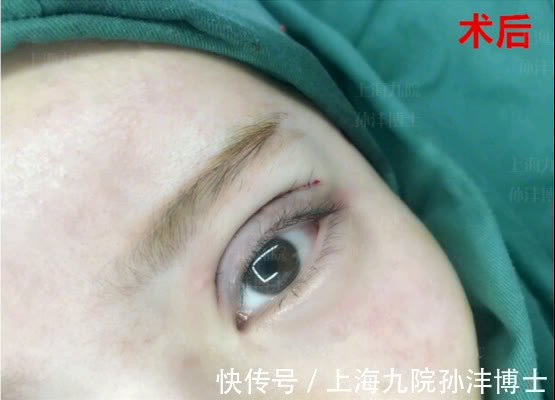 泪液 孙沣博士:双眼皮手术后,眼睛总爱流泪是正常情况吗?
