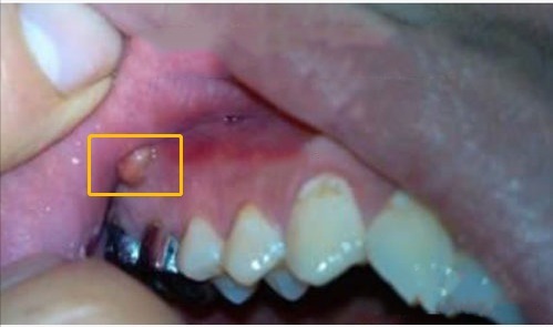 肿瘤|一歌手因牙龈癌去世,牙龈癌是什么病,它有什么症状