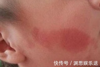 胎儿|女性怀孕后,几件事孕妇最好不要干,要不然出生的婴儿可能有胎记