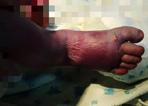 白天生|助产士接生太粗暴,蛮力拽双腿助产,双脚变紫蓝色