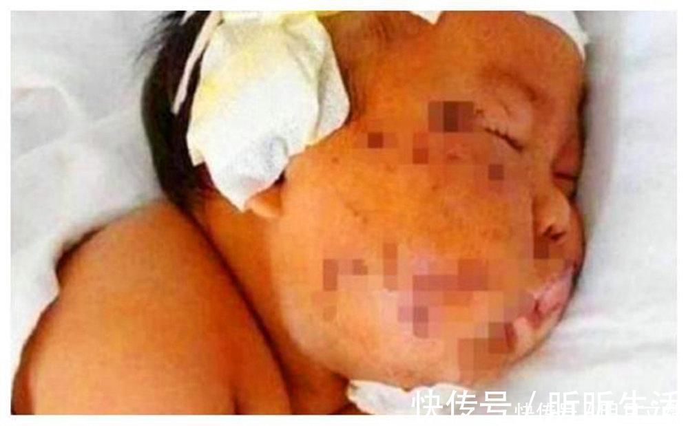 亲妈|5年过去,因吃奶太用力被亲妈“毁容”的婴儿现状如何?令人欣喜