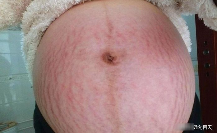 孕妈|有些孕妈为何会出现“妊娠纹”,但有些孕妈却没长?大夫讲了内情