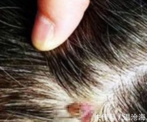 蜱虫|4岁女儿高烧不退,呕吐不止,拨开头发,怀孕准妈妈怒扇婆婆耳光