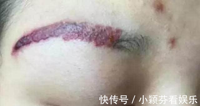 纹眉师|为什么医生不提倡女生“纹眉”?三个理由告诉你原因,幸好没跟风